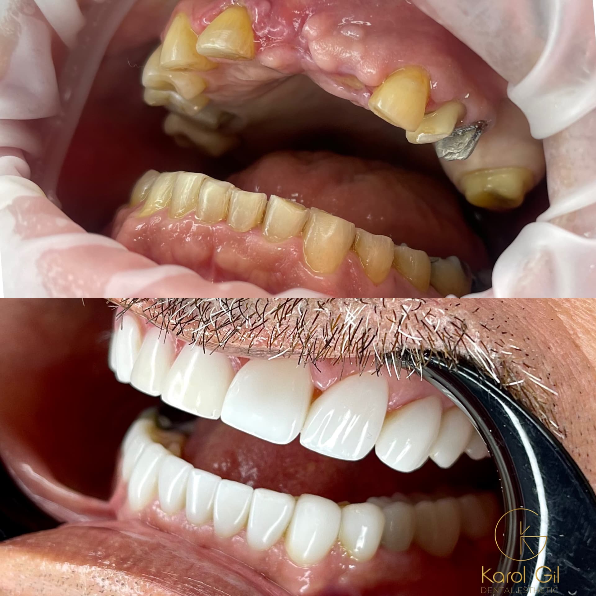 Real patient before and after treatment, case 4