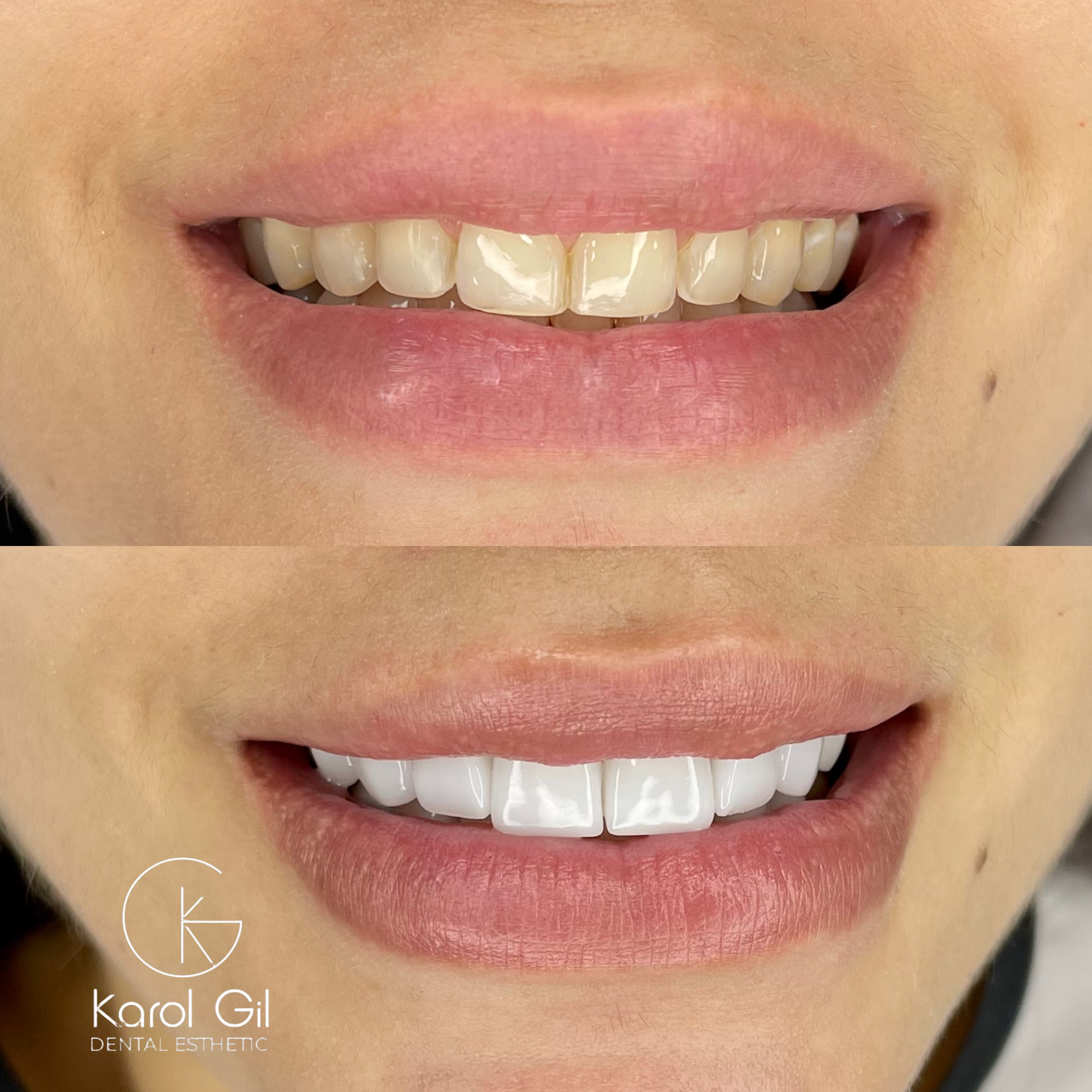 Real patient before and after treatment, case 2