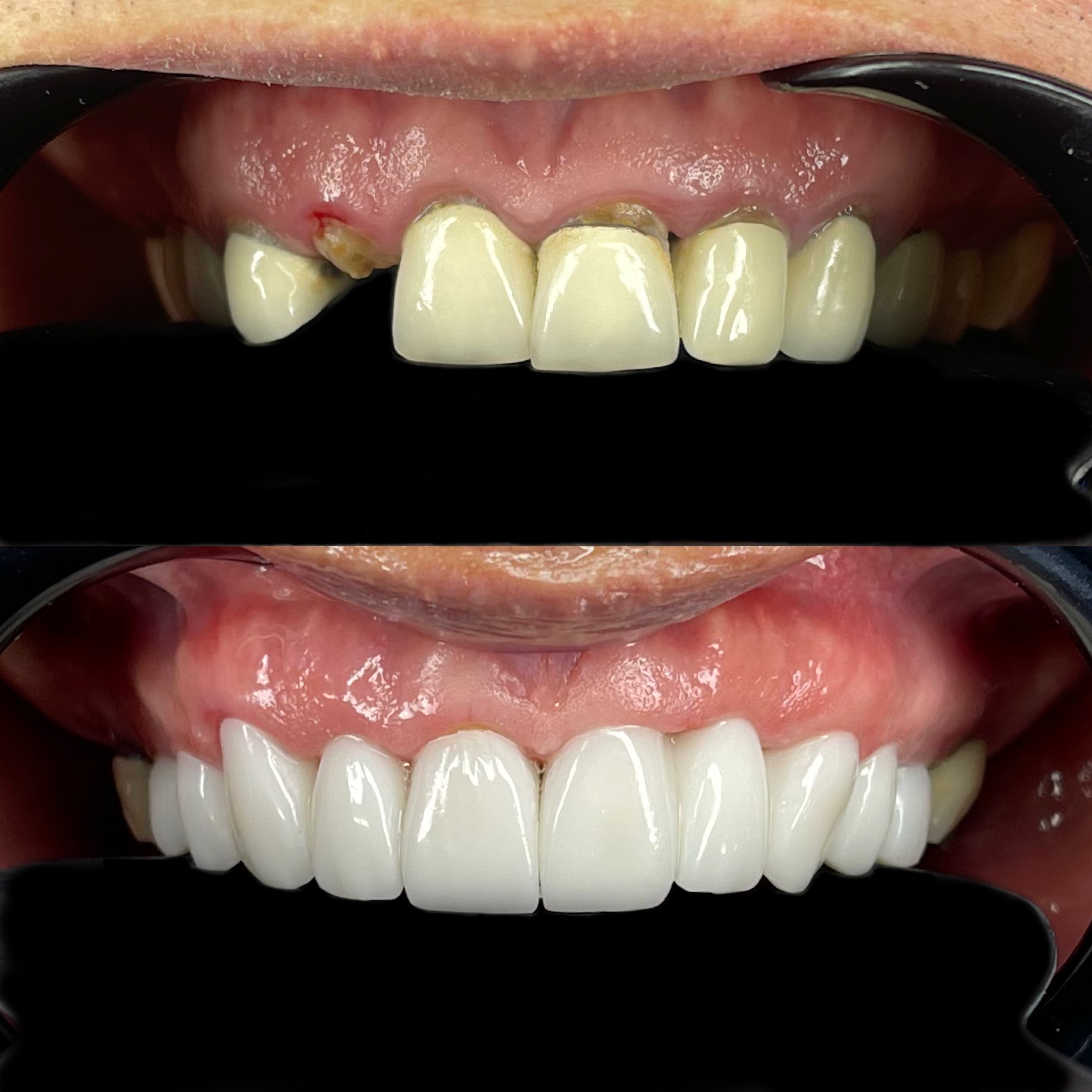 Real patient before and after treatment, case 5