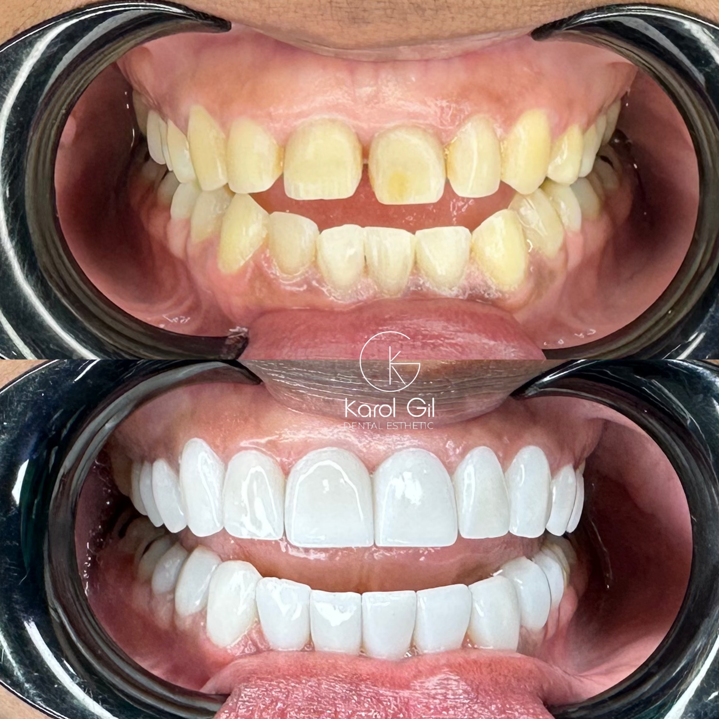 Real patient before and after treatment, case 6