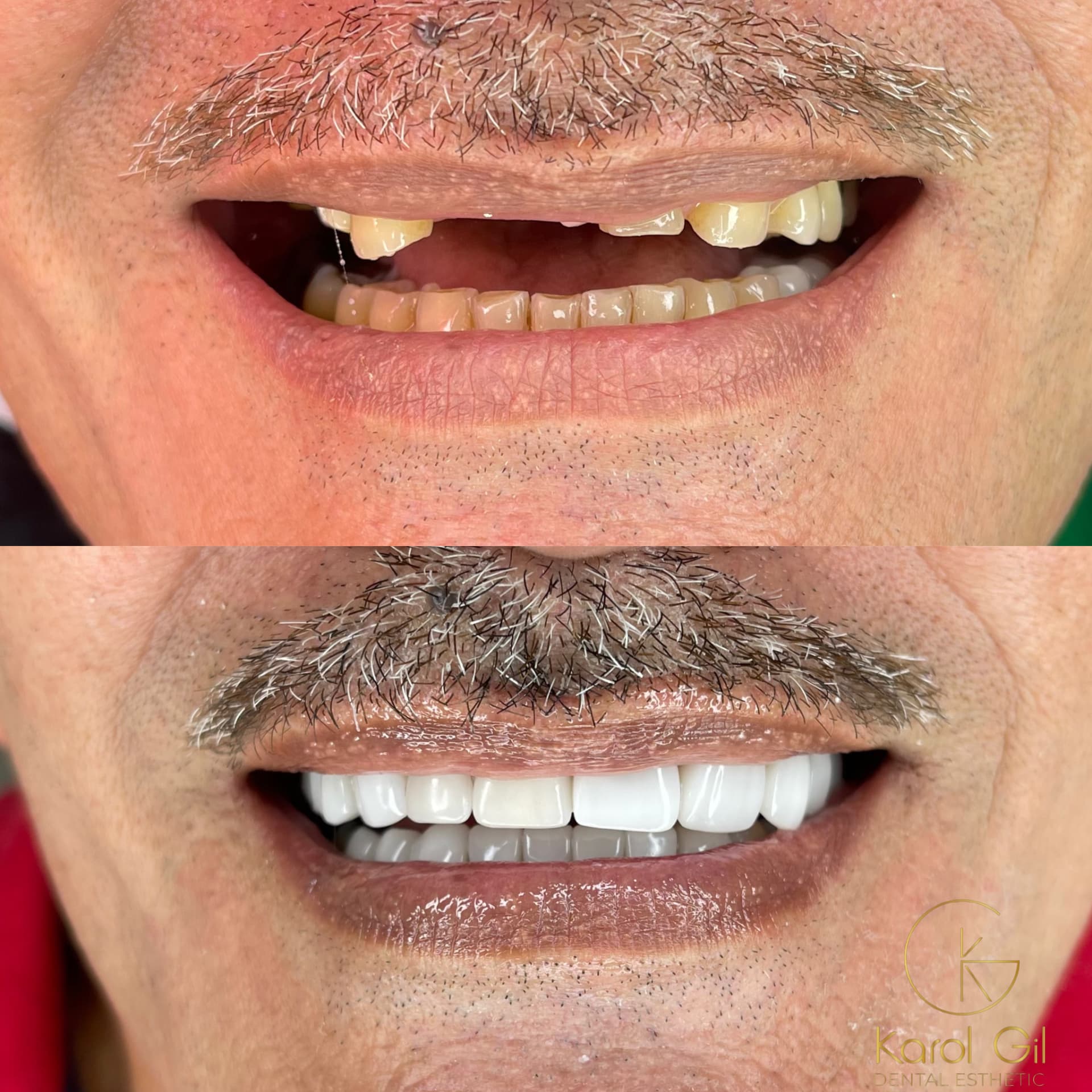 Real patient before and after treatment, case 1